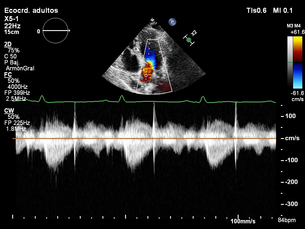 CW · mitral