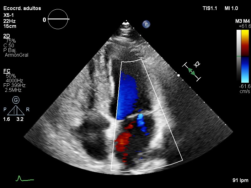 A4C color · mitral