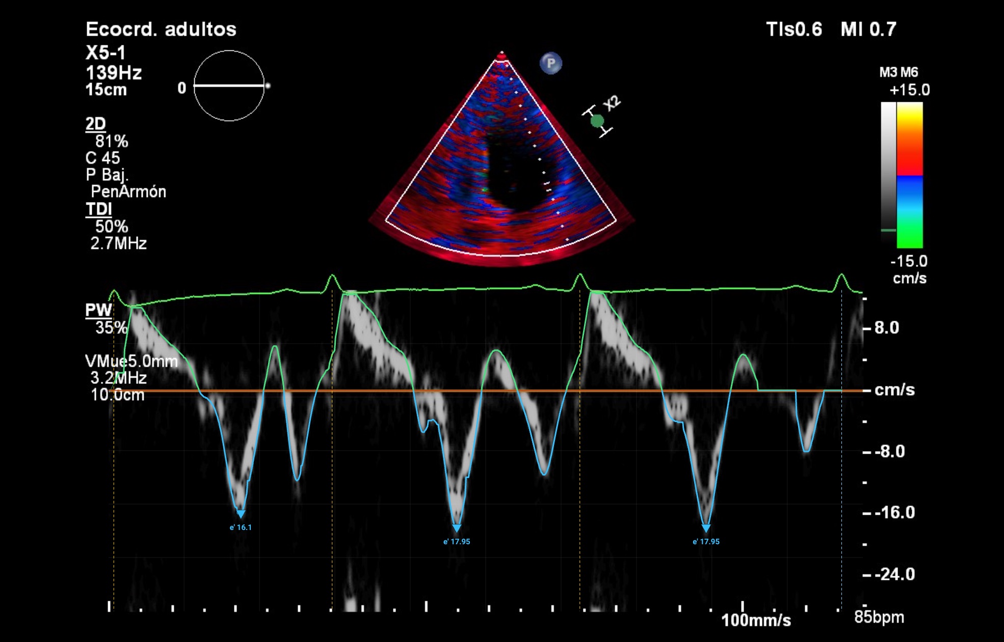 TDI · mitral lateral