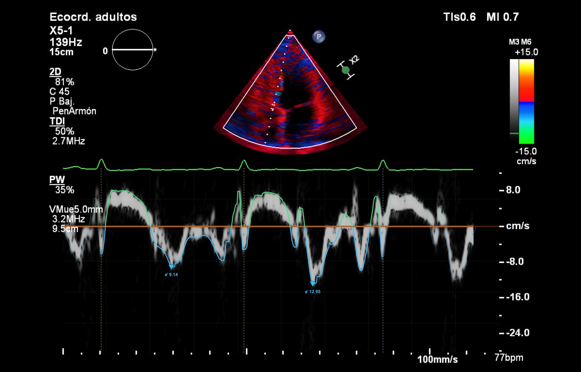 TDI · mitral septal