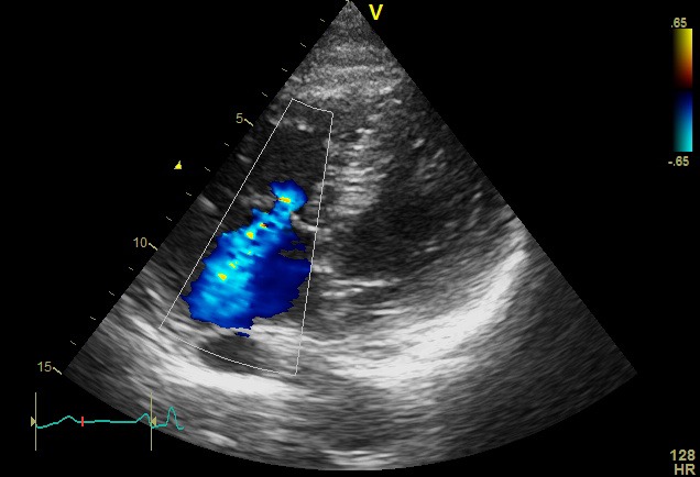 A4C color · tricuspídea